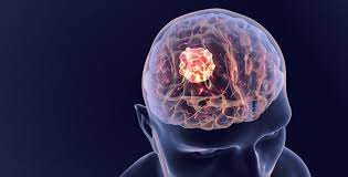 Mengenal 10 Tanda-Tanda Tumor Otak yang Sering Diabaikan: Panduan Luar Biasa untuk Deteksi Dini